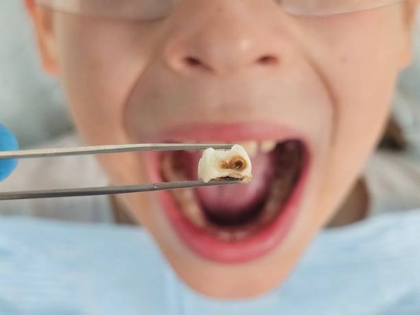 Best Emergency Treatment for Toothache in Alvin, TX